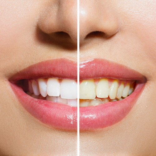 a before-and-after photo of teeth whitening