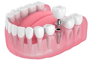 Illustration of a single dental implant