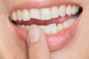 Closeup of smile with chipped front tooth