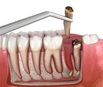 Illustration of forceps removing broken tooth 