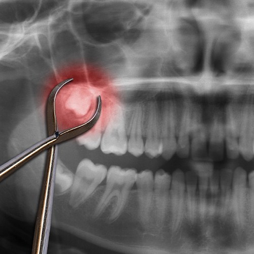 X ray of smile with impacted tooth before extraction