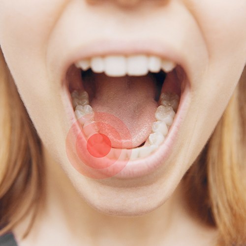 Closeup of smile with tooth that needs to be removed