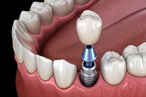 Animated smile during dental implant supported dental crown placement