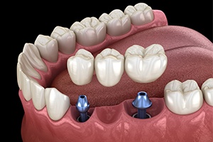 Animated smile during dental implant supported fixed bridge placement