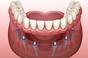 Animated smile during dental implant denture placement