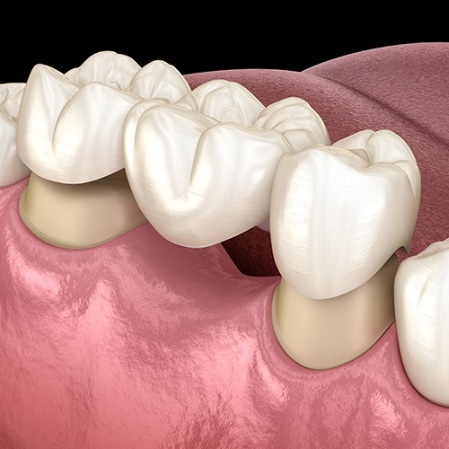 Animated smile during dental bridge placement to replace missing teeth