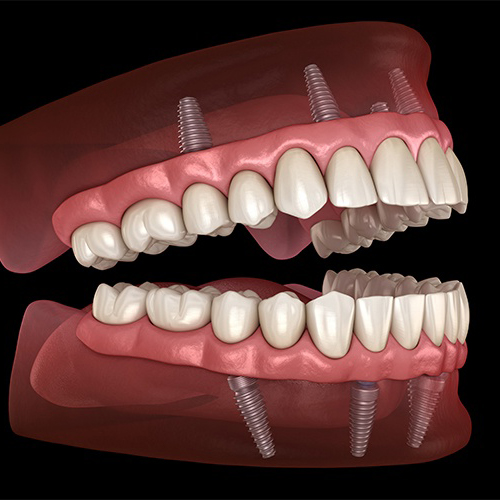 Animated smile with dental implant supported dentures