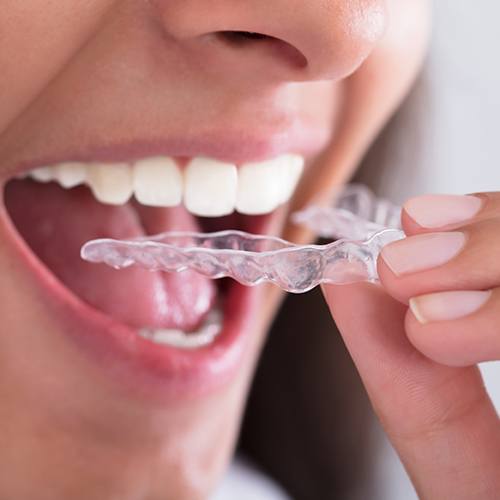 Closeup of dental patient placing Clear Correct clear braces tray