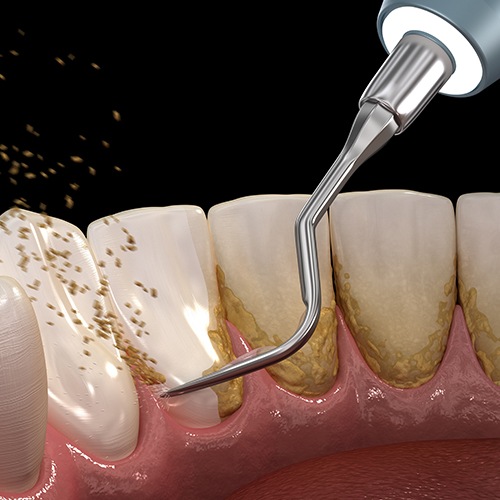 Animated smile during scaling and root planing gum disease treatment