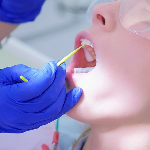 Closeup of dental patient receiving fluoride treatment