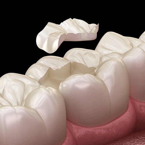 Animated smile during tooth colored filling placement