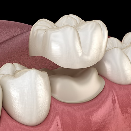 Animated smile during dental crown placement