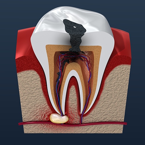 Animated tooth with damage before root canal treatment