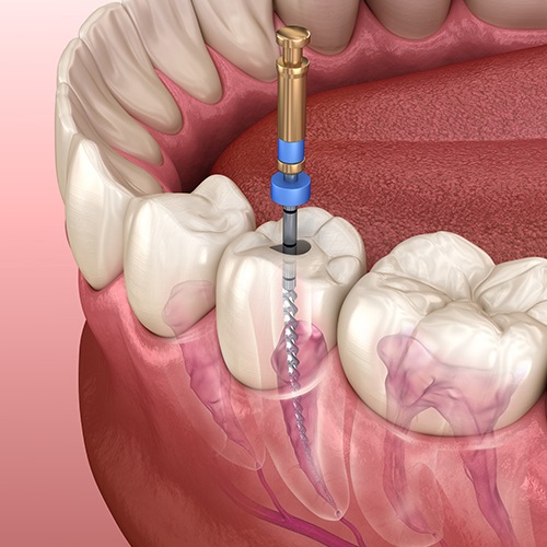 Animated smile during root canal treatment