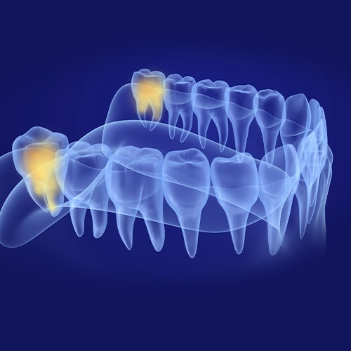 3 D rendering of wisdom teeth in need of extraction