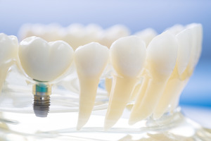 Close-up of dental implant in tray with model teeth