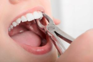 Close up of a dentist grabbing a tooth with forceps for an extraction