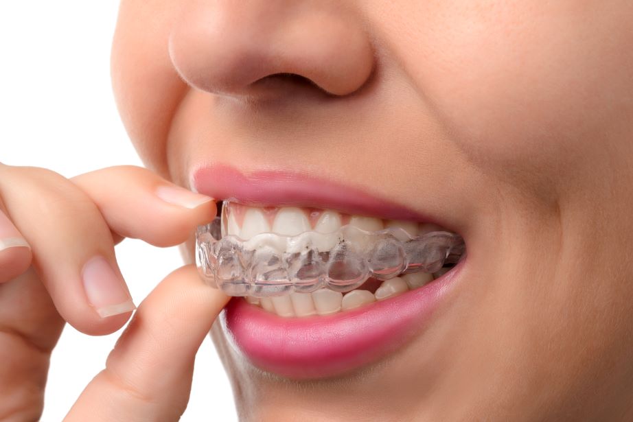 A woman putting on a ClearCorrect orthodontic aligner.